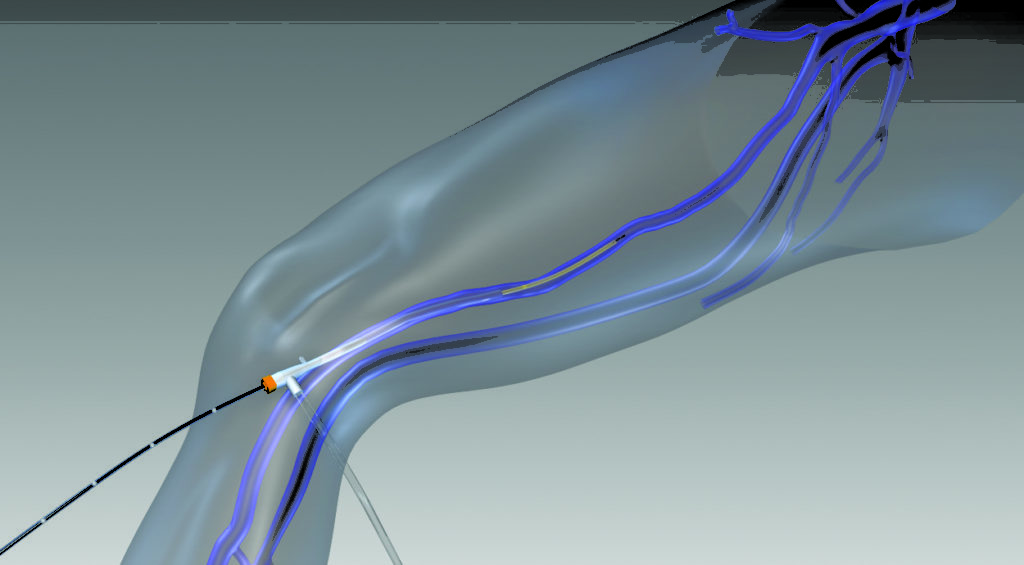 Pas De Retour Veineux Sur Chambre Implantable