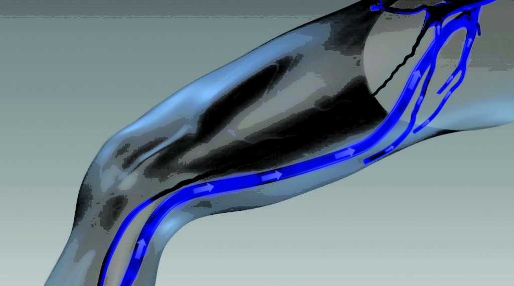 Endovenous ablation of varicose veins by radio frequency treatment